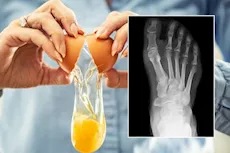  هل البيض مفيد لهشاشة العظام؟- إليك الإجابة "فيديوجرافيك"