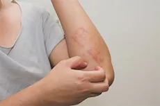 هذه أسباب حساسية الملح.. إليك طرق التعامل معها؟