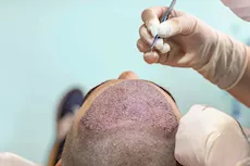 طبيبة تحذر: هذه أسباب فشل عملية زراعة الشعر "فيديو"    
