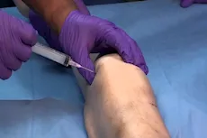 تحليل سائل الركبة قد يكشف مدى تآكل المفصل وشدة الألم.. دراسة توضح