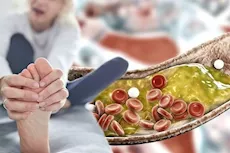 أعراض الكوليسترول على القدمين- 9 علامات تظهر في الصباخ 