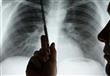 علامات تكشف الإصابة بسرطان الرئة