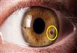 نقطة على حدقة العين