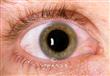 طرق لعلاج جفاف العيون