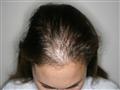 Can Female Hair Loss Make Me Totally Bald