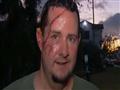 Man survives bear attack with 41 stitches across h