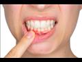 أمراض اللثة وضغط الدم 