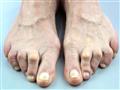  تعرف على أنواع تشوهات القدم وطرق علاجها