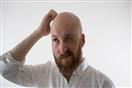 قشرة الرأس والصلع                                 