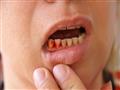 4 أسباب لنزيف اللثة.. وهذه طرق علاجها