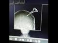 اشعة طبية توضح الاصابة (4)