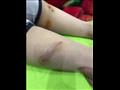 إصابات بالغة للطفل بعد مهاجمة الكلاب (8)