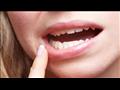  طرق علاج التهاب اللثة المزمن.. وكيفية الوقايه منه