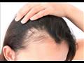 حل لتساقط الشعر