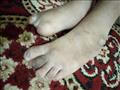 قدمي أحد الطفلين نتيحة المرض النادر