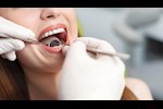 أيهما أفضل.. زراعة الأسنان الفورية أم العادية؟