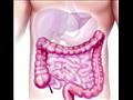 الكشف عن شكل الأمعاء المصابة بفيروس كورونا