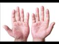 راحة اليد حمراء