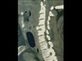 كسر مفتت فى الفقرات العنقية (4)