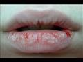 شفاه جافة أو متشققة