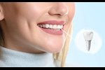 هل يمكن زرع الأسنان عند الإصابة بالسكري؟