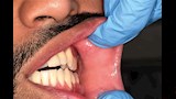 أعراض سرطان الفم