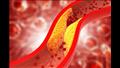 3 علامات خطيرة تشير إلى ارتفاع الكوليسترول في الدم 