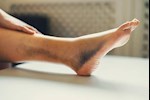 8 طرق لإذابة جلطة الساق- هل تكون فعالة؟ 