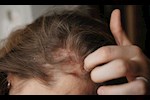  تينيا الشعر والثعلبة.. احذر الفرق بينهما