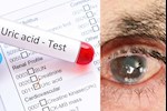 ماذا يحدث لعينيك عند ارتفاع حمض اليوريك بالدم؟