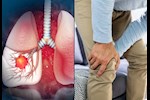 انتبه لساقيك- 6 أعراض مبكرة لسرطان الرئة تظهر عليهما
