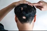 طبيبة: هذه الأطعمة تساهم في علاج الثعلبة