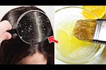 طبيب: هذه الوصفة تخلصك من قشرة الشعر نهائيًا