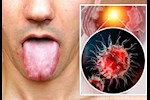 تظهر في الفم- علامة تكشف إصابتك بسرطان القولون