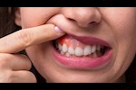 احذر.. نزيف اللثة قد يشير إلى نقص هذا المعدن بجسمك