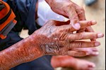 حسام موافي يحذر: هذا المرض يجعل جلدك مثل الجبس