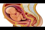الطفل المقعدي خلال الحمل.. تعرف على الأسباب والعلاج