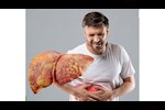 يعالج الكبد الدهني في هذه الحالة فقط- "FDA" توافق على دواء جديد
