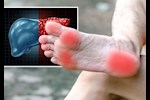 انتبه لقدميك- 6 أعراض لمرض الكبد الدهني تظهر عليهما