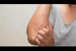 مرض سيلياك وحساسية القمح- ما الفرق بينهما؟