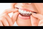 مميزات وعيوب التقويم الشفاف.. تعرف عليها