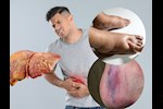 أعراض مرض الكبد الدهني المتقدم- 7 علامات تظهر على القدمين