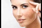 علاجات طبيعية لعلاج كلف الوجه عند النساء