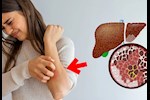 انتبه لبشرتك- 4 أعراض لتليف الكبد تظهر عليها