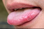 تكشف عن فيروس خطير- 6 أعراض تظهر في الفم احذرها