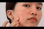5 نصائح للتخلص من البقع الداكنة لمرضى متلازمة تكيس المبايض 