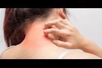 علامات تشير إلى الإصابة بحساسية الهيستامين؟