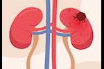 احذر- 5 أعراض مبكرة تكشف عن وجود ورم في كليتك