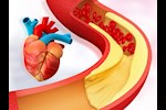 مثبتة علميًا- 4 مكملات غذائية لخفض الكوليسترول