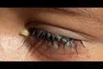 ما الذي يسبب سيلان اللعاب في العين وكيفية علاجه؟